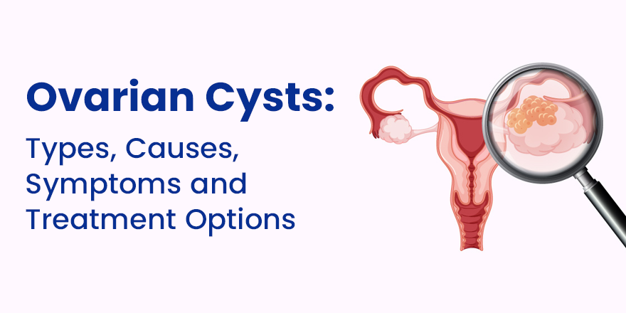 Ovarian Cysts: Types, Causes, Symptoms and Treatment Options